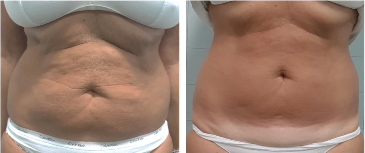 Ovation Med Spa Advances Body Contouring with New Non-Invasive Technology